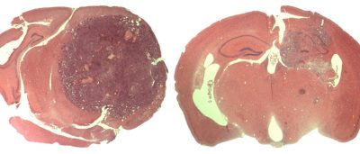scientists-find-key-driver-for-treatment-of-lethal-brain-cancer