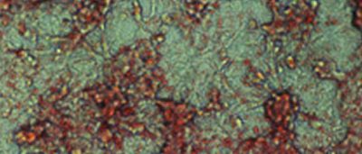 targeting-fat-treat-cancer
