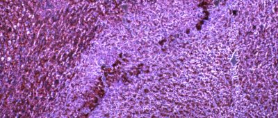 microrna-helps-cancer-evade-immune-system