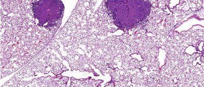 genetic-whodunit-cancer-gene-solved