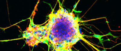 finding-a-cause-of-neurodevelopmental-disorders
