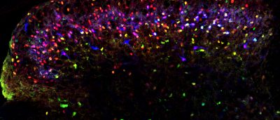 new-clues-why-gold-standard-treatment-for-bipolar-disorder-doesnt-work-for-majority-of-patients