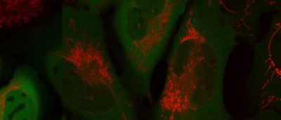 parkinsons-cancer-type-2-diabetes-share-a-key-element-that-drives-disease