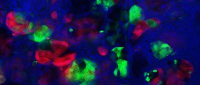how-injury-to-the-pancreas-influences-cancer-development