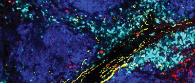 reducing-stress-on-t-cells-makes-them-better-cancer-fighters