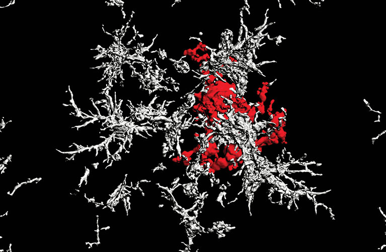 24-fall-frontiers-amyloid-plaque